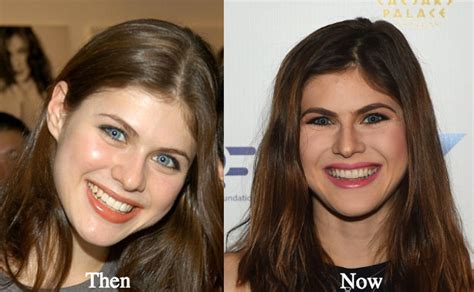 alexandra daddario breast reduction|Alexandra Daddario Breast Job – Before and After Pictures